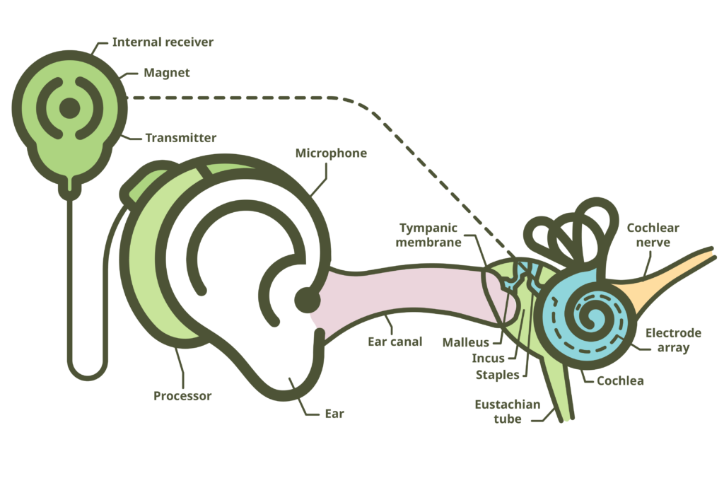 Cochlear Implants Rnid